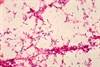 Pneumonia Outcomes Predicted by Time to Positivity of Blood Culture Pneumonia Outcomes Predicted by Time to Positivity of Blood Culture