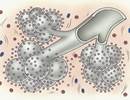 Predicting Survival Trajectories in IPF Using 2 T-Cell Biomarkers Predicting Survival Trajectories in IPF Using 2 T-Cell Biomarkers