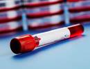 Biomarkers of PAH Risk in Patients With SLE Biomarkers of PAH Risk in Patients With SLE