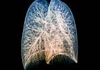 Pulmonary Involvement in Antineutrophil Cytoplasmic Antibodies-Associated Vasculitis Pulmonary Involvement in Antineutrophil Cytoplasmic Antibodies-Associated Vasculitis