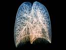 Predicting Survival in IPF With CT-Measured Pulmonary Artery: Aorta Ratio Predicting Survival in IPF With CT-Measured Pulmonary Artery: Aorta Ratio