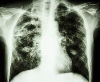 There is a need to increase preventative therapy and target a population who are considered high risk for developing tuberculosis. There is a need to increase preventative therapy and target a population who are considered high risk for developing tuberculosis.