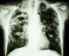 Time to Sputum Culture Conversion in Isoniazid-Resistant Tuberculosis Time to Sputum Culture Conversion in Isoniazid-Resistant Tuberculosis