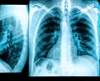 Sildenafil, Bosentan Combination vs Sildenafil Monotherapy in SSc-Associated PAH Sildenafil, Bosentan Combination vs Sildenafil Monotherapy in SSc-Associated PAH