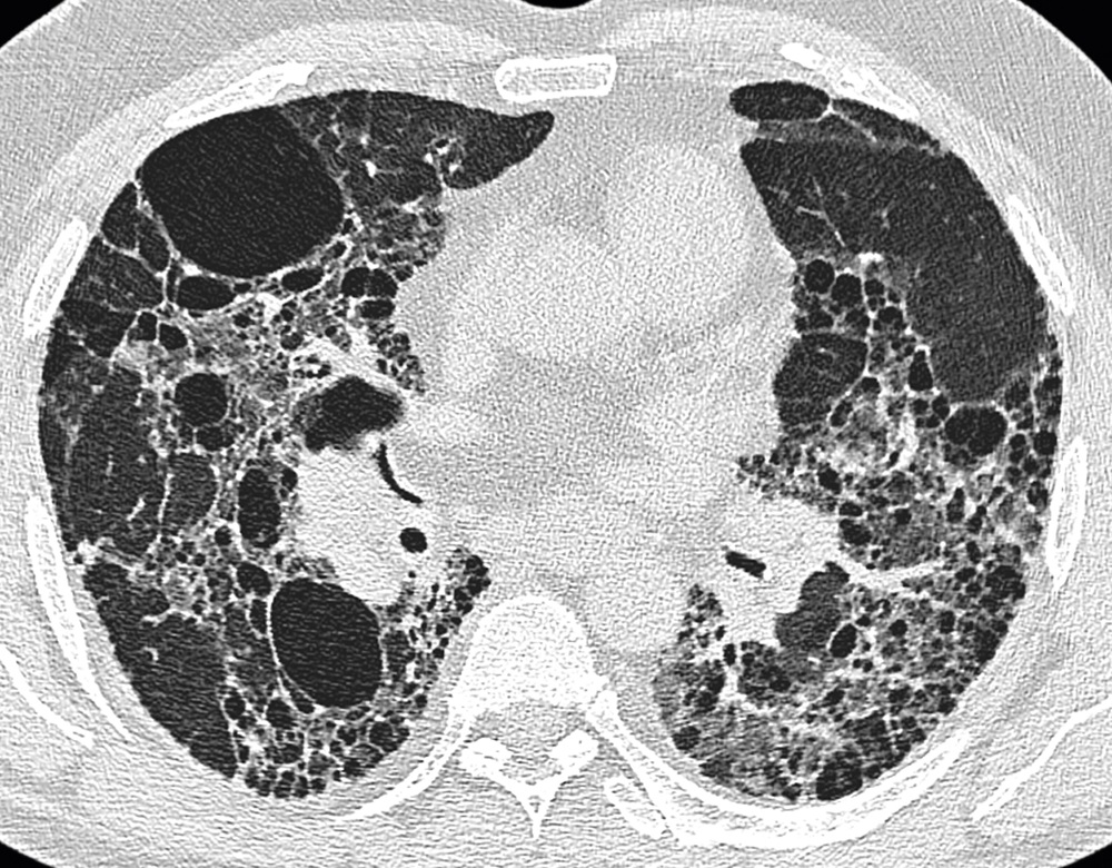 walk heart patients failure test 6 minute Idiopathic Minute 6 Fibrosis Walk of Test Pulmonary in Use