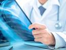 Comparing Treatments for Acute Respiratory Distress Syndrome Comparing Treatments for Acute Respiratory Distress Syndrome