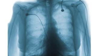 Rheumatoid arthritis has been associated with common obstructive lung diseases. Rheumatoid arthritis has been associated with common obstructive lung diseases.