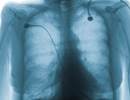 LABA Plus LAMA Therapy Associated With Fewer Exacerbations in COPD LABA Plus LAMA Therapy Associated With Fewer Exacerbations in COPD