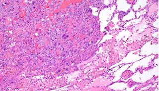 Less than a year following the initial direct-to-tumor vaccine injection, all of the treated tumors disappeared. Less than a year following the initial direct-to-tumor vaccine injection, all of the treated tumors disappeared.