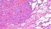 Glucose Dependency in Squamous Cell vs Adenocarcinoma NSCLC Tumors Glucose Dependency in Squamous Cell vs Adenocarcinoma NSCLC Tumors