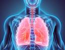 Morbidity, Mortality in VZV-Related Community-Acquired Pneumonia Morbidity, Mortality in VZV-Related Community-Acquired Pneumonia
