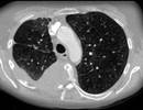 Adjuvant Pembrolizumab Beneficial in Metastatic NSCLC Adjuvant Pembrolizumab Beneficial in Metastatic NSCLC
