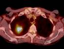 Updated Lung Cancer Screening Guidelines Released at CHEST Updated Lung Cancer Screening Guidelines Released at CHEST