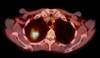 Diagnostic Test Can Identify Biomarkers to Detect Lung Cancer Diagnostic Test Can Identify Biomarkers to Detect Lung Cancer