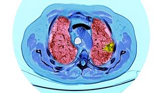 Patients with ES-SCLC enrolled in the study were required to begin maintenance therapy within 8 weeks of completing chemotherapy. Patients with ES-SCLC enrolled in the study were required to begin maintenance therapy within 8 weeks of completing chemotherapy.