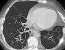 Cystic Fibrosis Lung Function Improved With Triple Therapy Cystic Fibrosis Lung Function Improved With Triple Therapy