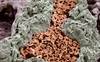 Safety, Efficacy of Treprostinil Delivery System for PAH Examined Safety, Efficacy of Treprostinil Delivery System for PAH Examined