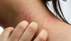 Low Vitamin D Levels Not Associated With Risk of Atopy Low Vitamin D Levels Not Associated With Risk of Atopy