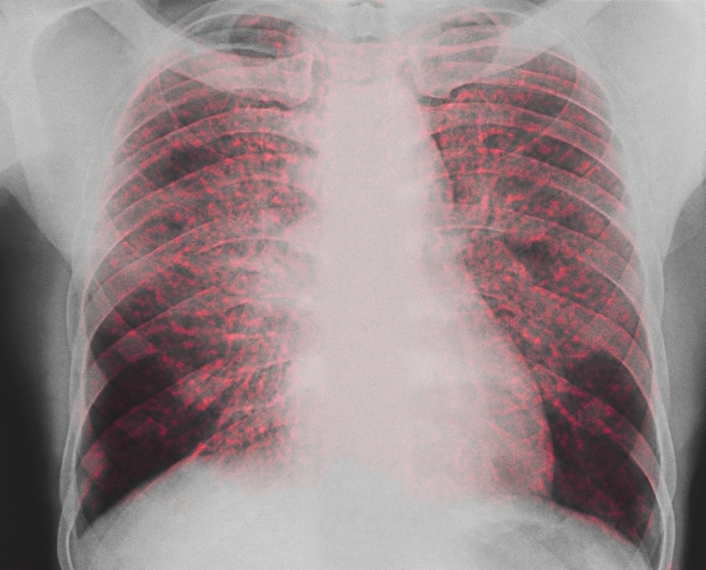 pulmonary-sarcoidosis-independent-predictors-of-mortality