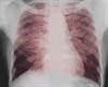 Pulmonary Sarcoidosis: Independent Predictors of Mortality Pulmonary Sarcoidosis: Independent Predictors of Mortality