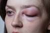 Hereditary Angioedema Breakthrough Attacks Successfully Treated With Icatibant Hereditary Angioedema Breakthrough Attacks Successfully Treated With Icatibant