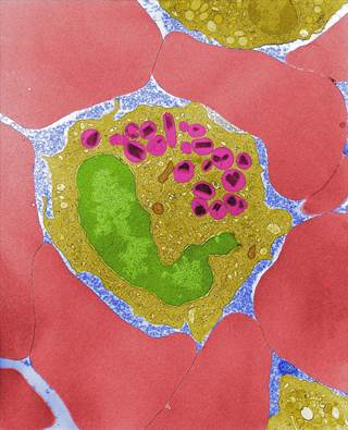 Sputum eosinophil levels decreased with FEV1 improvement and response to inhaled corticosteroid treatment. Sputum eosinophil levels decreased with FEV1 improvement and response to inhaled corticosteroid treatment.