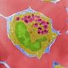 Sputum Eosinophil Levels Correlate With Asthma Severity Sputum Eosinophil Levels Correlate With Asthma Severity