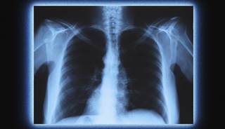 A significant interaction was noted between race and fluid treatments. A significant interaction was noted between race and fluid treatments.