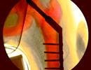 Fracture Risk in COPD Increases With Extended Duration of Corticosteroid Use Fracture Risk in COPD Increases With Extended Duration of Corticosteroid Use