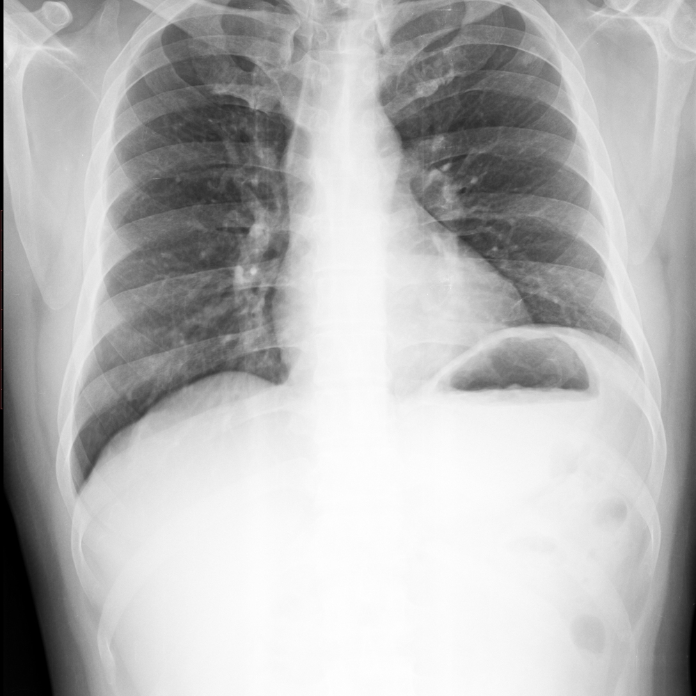 lung mass