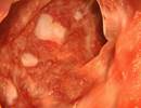 Association Between Asthma and Inflammatory Bowel Disease Examined Association Between Asthma and Inflammatory Bowel Disease Examined