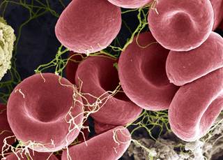 Researchers conducted coagulation tests in patients with OSA to assess the potential association between hypercoagulability and severity of OSA. Researchers conducted coagulation tests in patients with OSA to assess the potential association between hypercoagulability and severity of OSA.