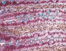 Celiac Disease in High-Risk Children: Do Respiratory Infections Increase Risk? Celiac Disease in High-Risk Children: Do Respiratory Infections Increase Risk?