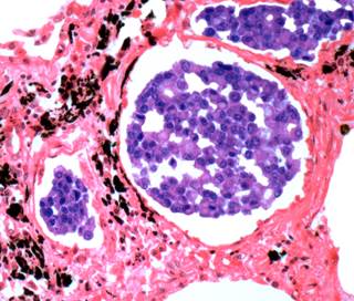 More stringent pathologic nodal staging quality strata were used in this study. More stringent pathologic nodal staging quality strata were used in this study.