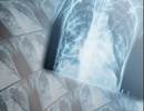 Beta Blockers Linked to Longer Life Expectancy in COPD Beta Blockers Linked to Longer Life Expectancy in COPD