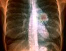 Lung Cancer Screening Implementation Guide Developed Lung Cancer Screening Implementation Guide Developed