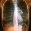 Does Targeted Inflammation Therapy Reduce Risk of CV Events, Lung Cancer? Does Targeted Inflammation Therapy Reduce Risk of CV Events, Lung Cancer?