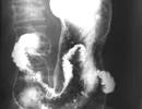 Delayed Gastric Motility Post-Lung Transplantation in Patients With No Prior GI Surgery Delayed Gastric Motility Post-Lung Transplantation in Patients With No Prior GI Surgery
