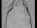 ESC Updates Guidelines for Multidisciplinary Approaches to Peripheral Arterial Disease Tx ESC Updates Guidelines for Multidisciplinary Approaches to Peripheral Arterial Disease Tx