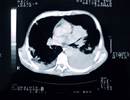 Pembrolizumab Combination Approved for First-Line Metastatic Squamous NSCLC Treatment Pembrolizumab Combination Approved for First-Line Metastatic Squamous NSCLC Treatment