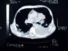 Does CT Scan at Follow-up Improve Resected NSCLC Survival? Does CT Scan at Follow-up Improve Resected NSCLC Survival?