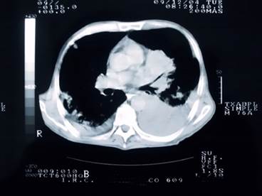 Lung Cancer Imaging in Asymptomatic Patients: To Screen or Not to Screen? Lung Cancer Imaging in Asymptomatic Patients: To Screen or Not to Screen?