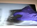 Ventilator-Induced Lung Injury in Acute Respiratory Distress Syndrome Ventilator-Induced Lung Injury in Acute Respiratory Distress Syndrome