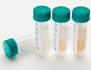 Airway Mucin May Serve as Confirmatory Biomarker for Chronic Bronchitis Airway Mucin May Serve as Confirmatory Biomarker for Chronic Bronchitis