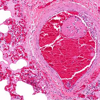 Researchers analyzed data on cardiovascular risk factors from >1.1 million participants in 76 cohorts. Researchers analyzed data on cardiovascular risk factors from >1.1 million participants in 76 cohorts.