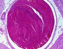 No Increased Risk for VTE After Flu Vaccine in People Older Than 50 No Increased Risk for VTE After Flu Vaccine in People Older Than 50