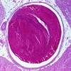 Rivaroxaban in VTE: Lower Clinical Event Costs, But Higher Healthcare Costs Rivaroxaban in VTE: Lower Clinical Event Costs, But Higher Healthcare Costs