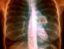 Lung Cancer Postoperative Complications Reduced With Preoperative Exercise Lung Cancer Postoperative Complications Reduced With Preoperative Exercise