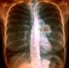 Lung Cancer Survival May Be Predicted by BMI and Age Lung Cancer Survival May Be Predicted by BMI and Age