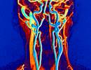 Potential Effect of CPAP on Carotid Intima-Media Thickness Potential Effect of CPAP on Carotid Intima-Media Thickness